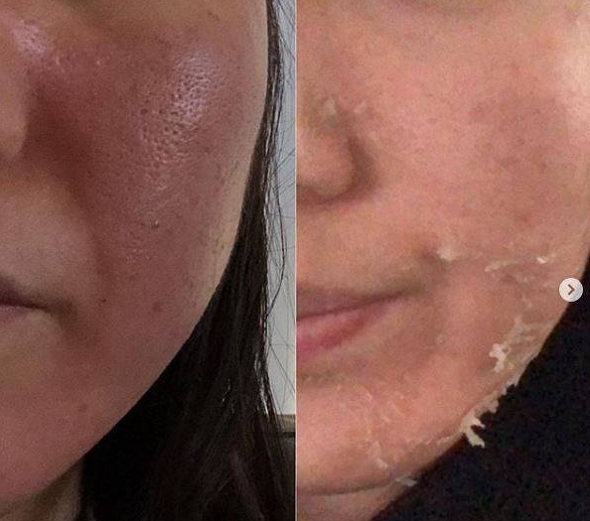 sạm da dùng retinol