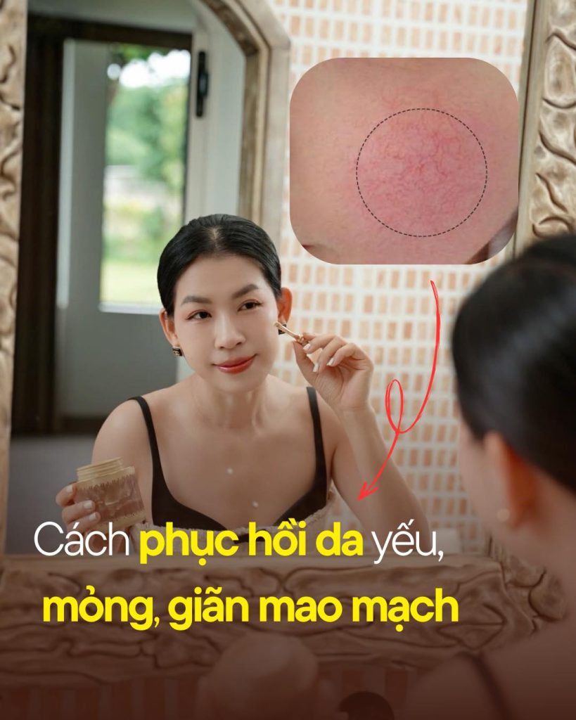 Cách phục hồi da lộ mao mạch